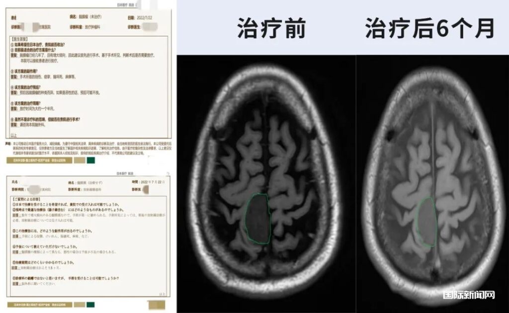 抗癌战线上的“颠覆者”夏廷毅：用精准放疗造福肿瘤患者！